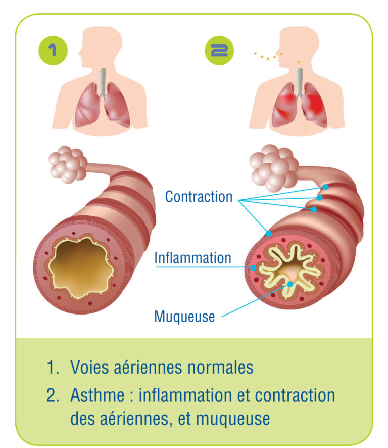 asthmatique, asthme, labosalem