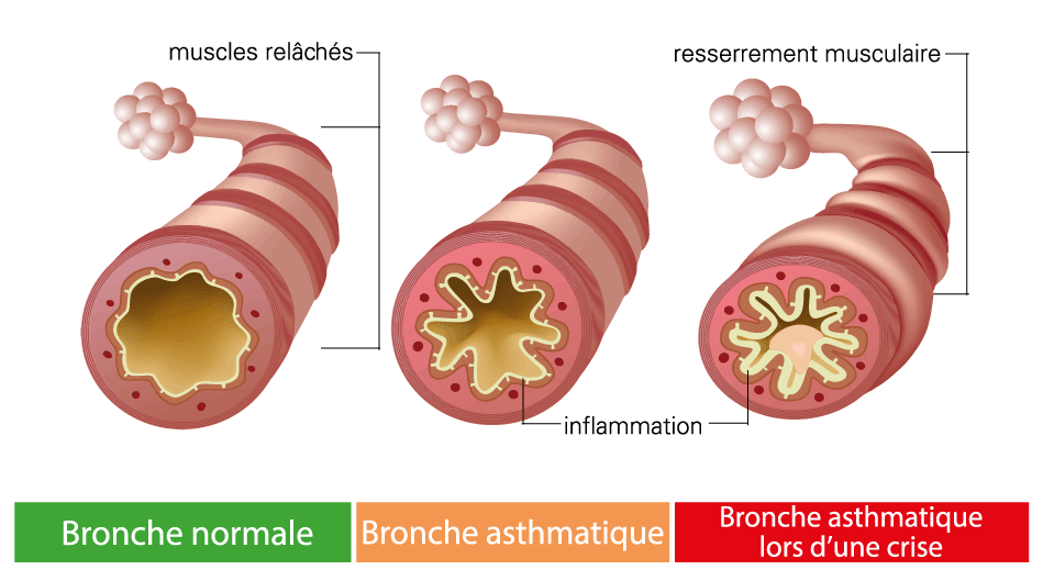 bronche asmatique, asmatique, bronche, labosalem