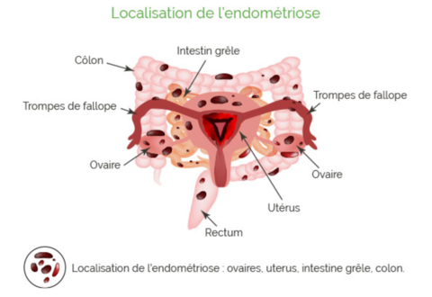 localisation de l'endométriose, endométriose, labosalem